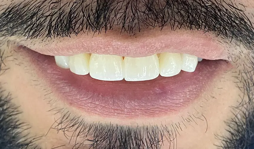 After dental veneers transformation Las Vegas patient 1
